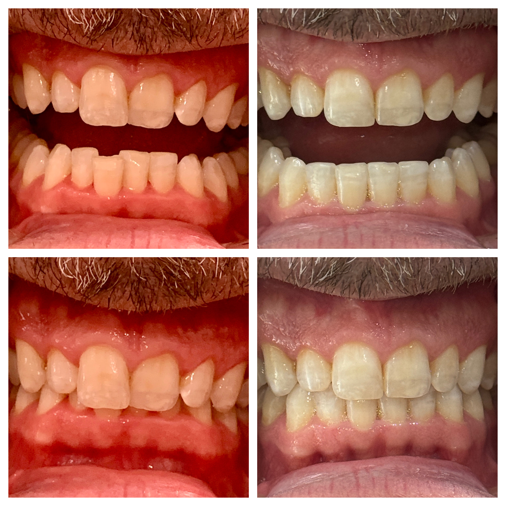 Pleasant Smiles | Extractions, Oral Exams and Veneers