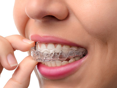 The image shows a person holding an Invisalign aligner, which is a clear orthodontic device used for teeth straightening, with their hand partially visible above their mouth.