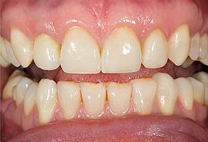 The image shows a close-up view of a person s teeth with yellowing, indicating possible dental issues such as staining or decay.