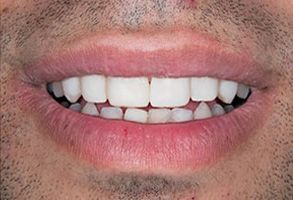 The image shows a close-up of a person s mouth with teeth, displaying a smile with a visible gap between two front teeth.