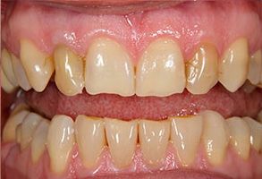 The image shows a close-up view of a person s teeth with yellowing and staining, indicating poor oral hygiene or dental issues.