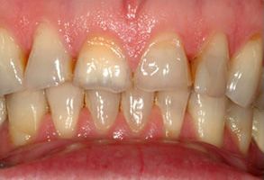 The image shows a close-up view of a person s mouth with visible yellowing on the teeth, suggesting poor oral hygiene or possible dental issues.