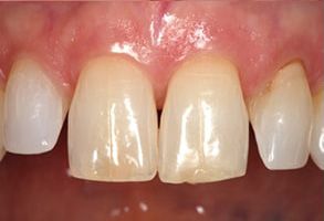 The image shows a close-up view of a person s teeth with a focus on a yellowish discoloration, particularly around the front teeth, which appear to be undergoing cosmetic dental treatment.